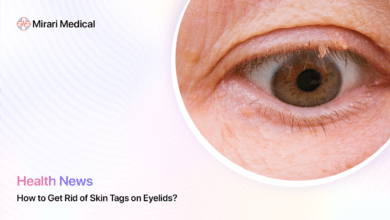 How To Get Rid Of Skin Tags On Eyelids