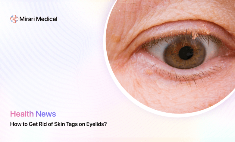 How To Get Rid Of Skin Tags On Eyelids