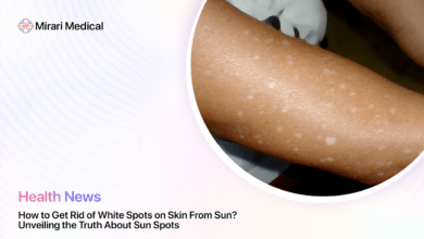 How To Get Rid Of White Spots On Skin From Sun