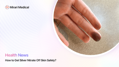 How To Get Silver Nitrate Off Skin