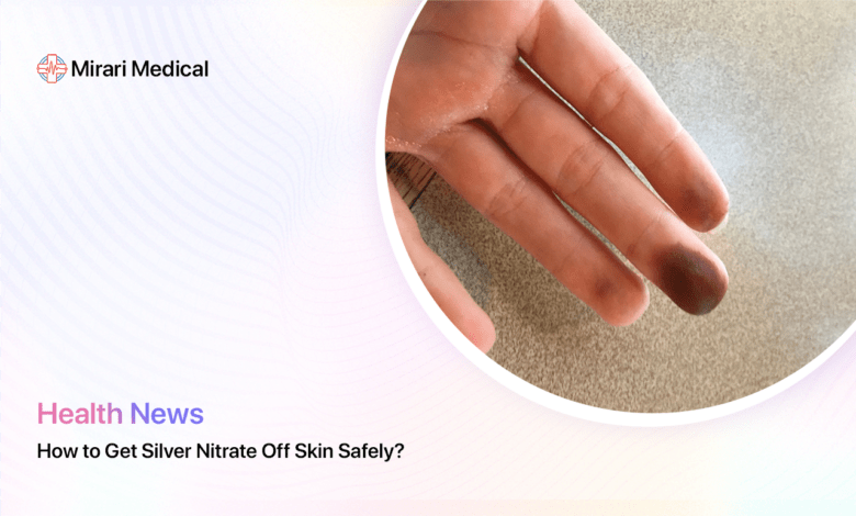 How To Get Silver Nitrate Off Skin