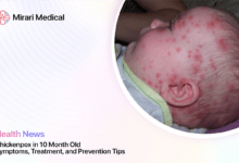 Chickenpox In 10 Month Old