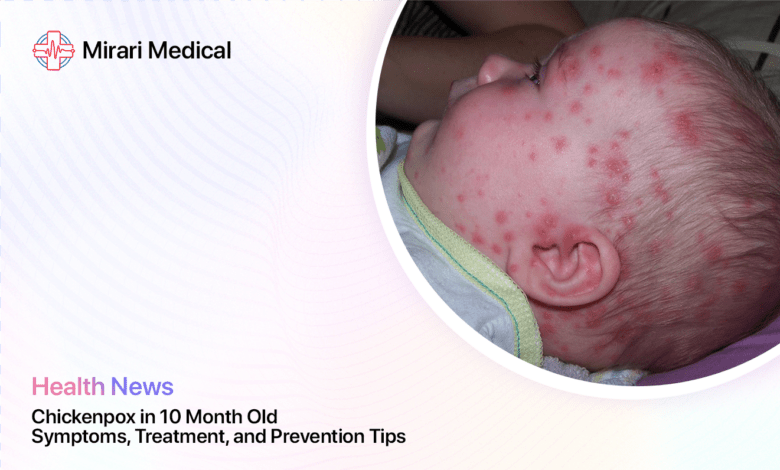 Chickenpox In 10 Month Old