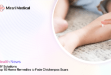 Home Remedies For Chickenpox Scars