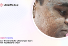 Laser Treatment For Chickenpox Scars