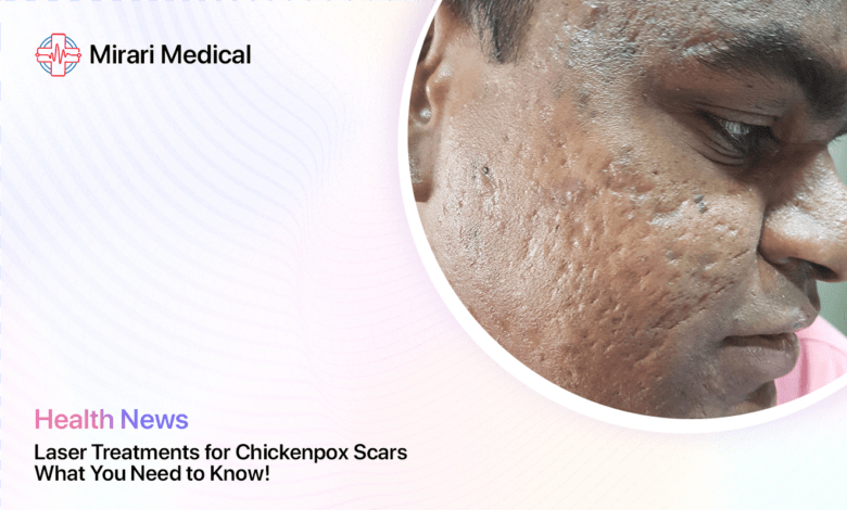 Laser Treatment For Chickenpox Scars