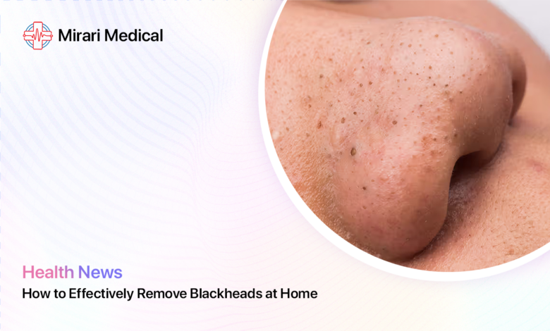 Blackhead Removal