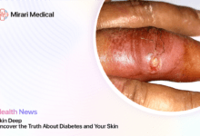 Diabetes And Skin Health