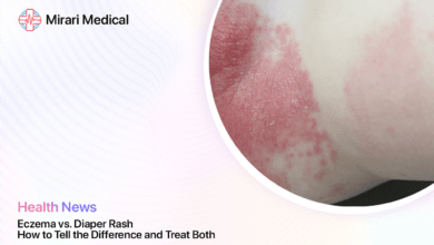 Diaper Rash And Eczema